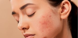 Léčba akné pomocí CBD oleje